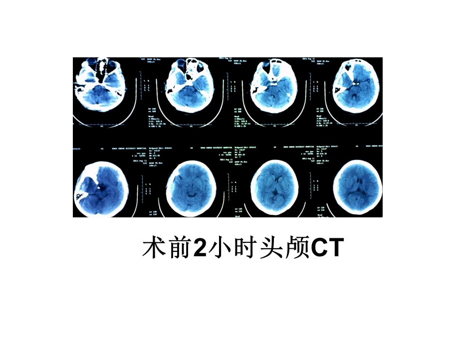 硬膜外血肿病例分析ppt课件.ppt_第2页