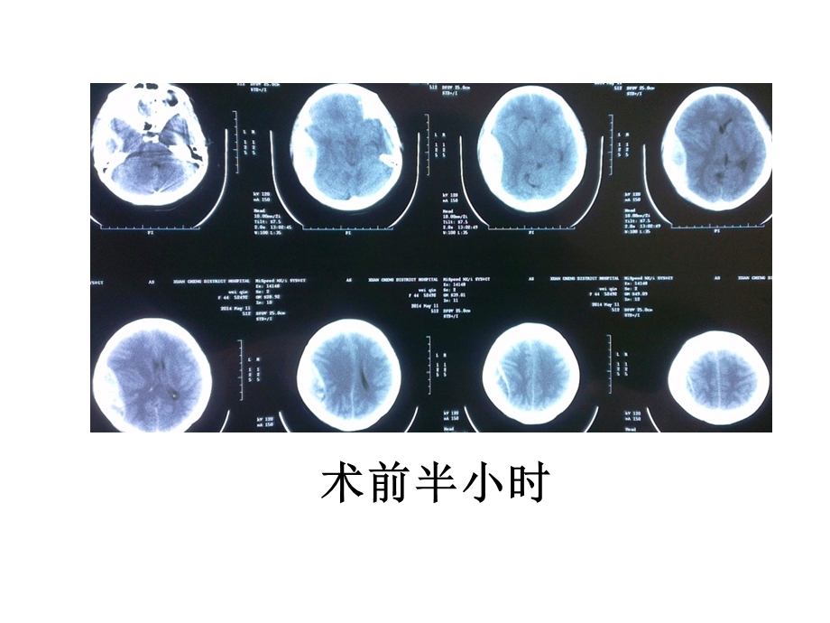 硬膜外血肿病例分析ppt课件.ppt_第3页