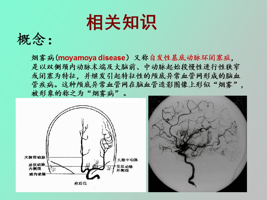 烟雾病护理查房史小曼.ppt_第2页