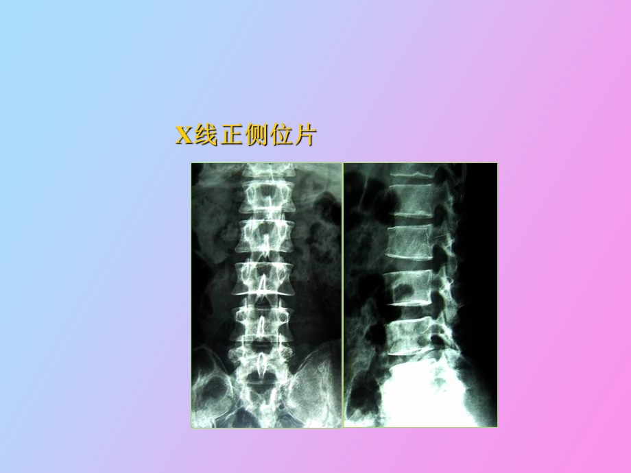 腰椎间盘突出症的手术治疗.ppt_第3页