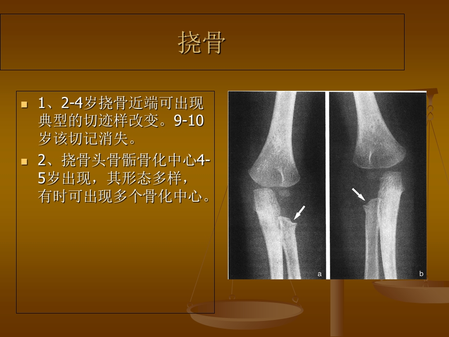 肘关节X线表现.ppt_第2页