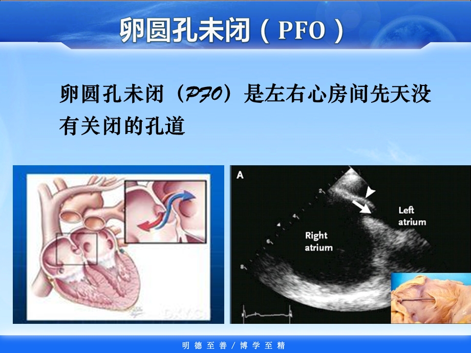 张明宇 卵圆孔未闭封堵治疗.ppt_第2页