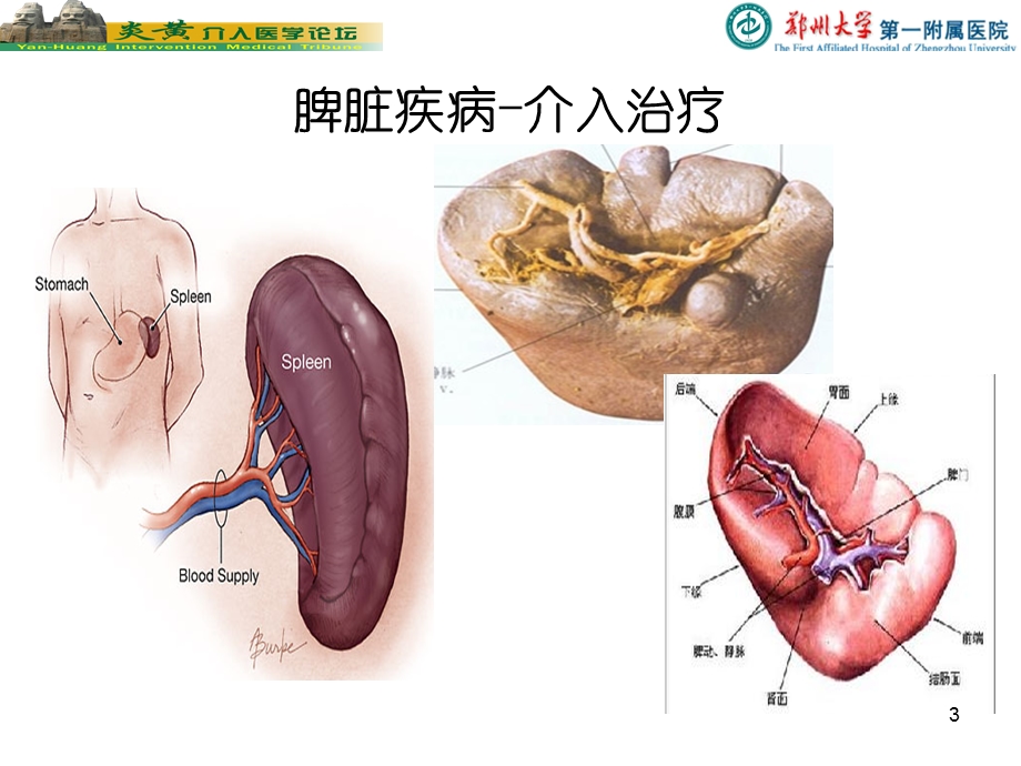 脾脏的介入栓塞治疗.ppt_第3页