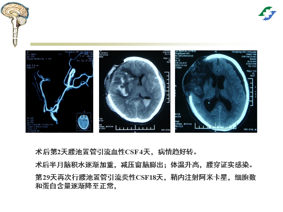 腰大池穿刺置管引流术.ppt_第3页