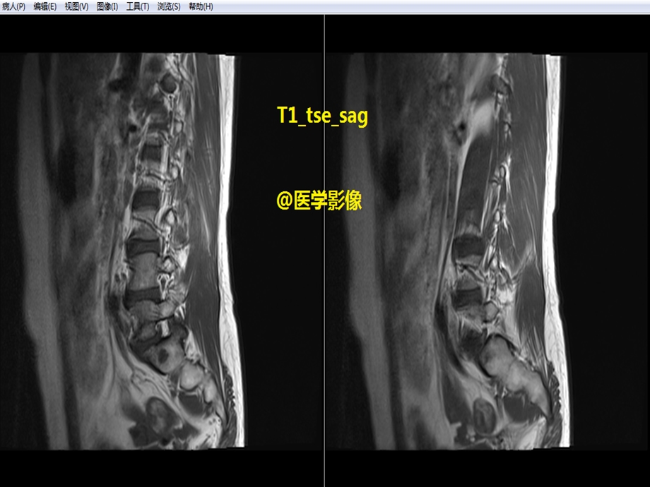 腰椎体血管瘤MRI表现.ppt_第1页