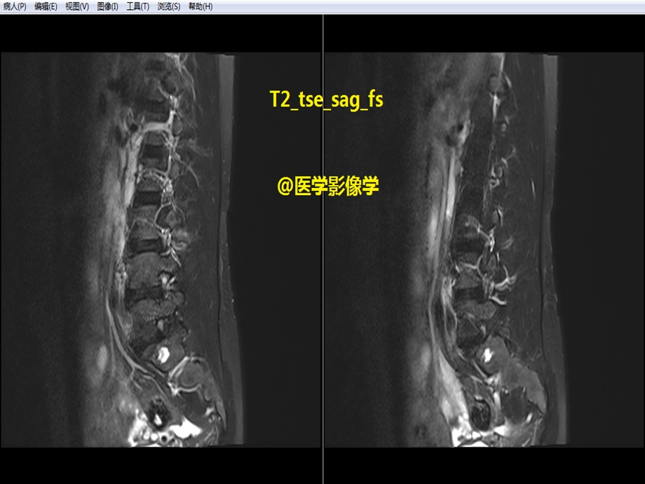 腰椎体血管瘤MRI表现.ppt_第3页