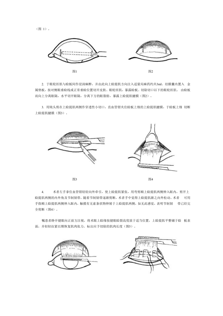 上睑提肌缩短和徙前术.docx_第2页