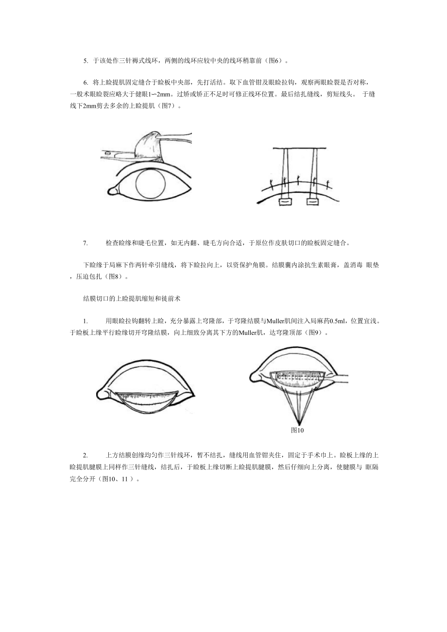 上睑提肌缩短和徙前术.docx_第3页