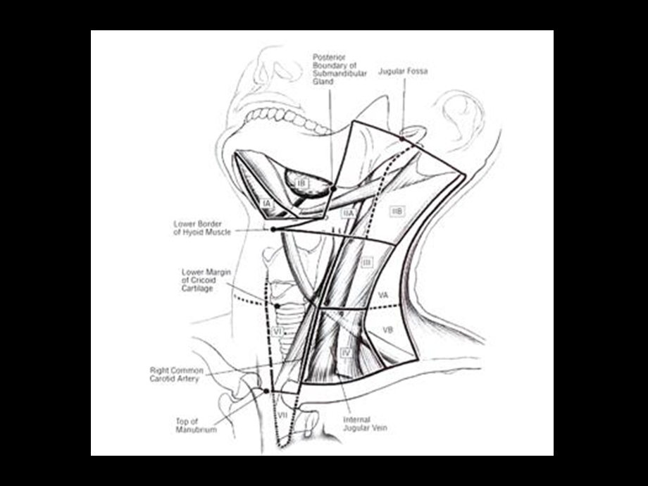 颈部淋巴结分区及诊断.ppt_第2页