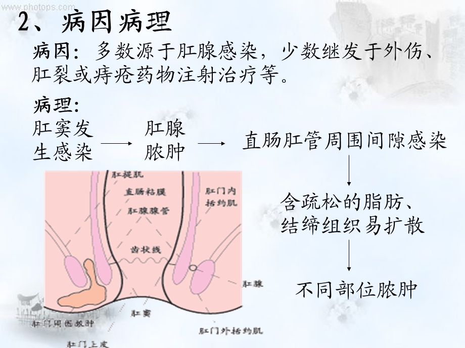 肛周脓肿护理查房.ppt_第3页