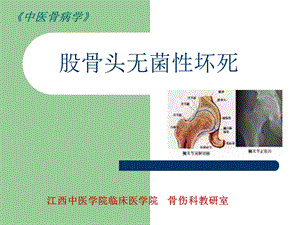 《中西医结合骨伤科学》股骨头坏死.ppt