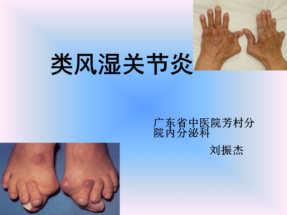 中西结合7年制教材(大量图片)类风湿性关节炎.ppt_第1页