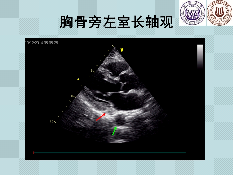 隐藏于标准切面的心脏结构.ppt_第2页