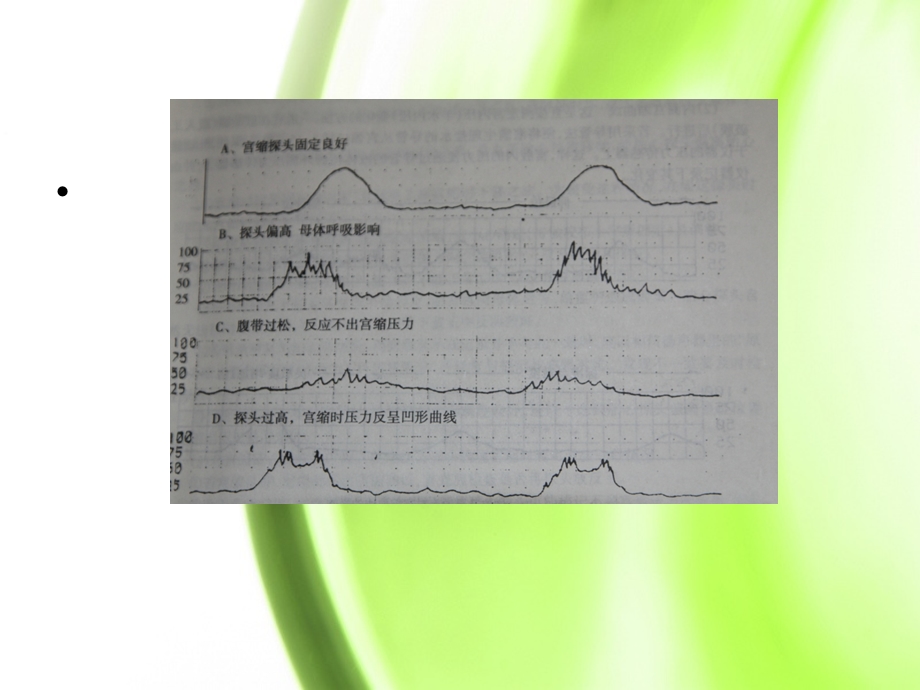 胎心监护王俊英ppt课件.ppt_第3页