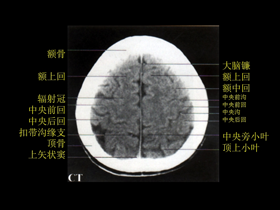 颅脑正常CT和MRI.ppt_第3页