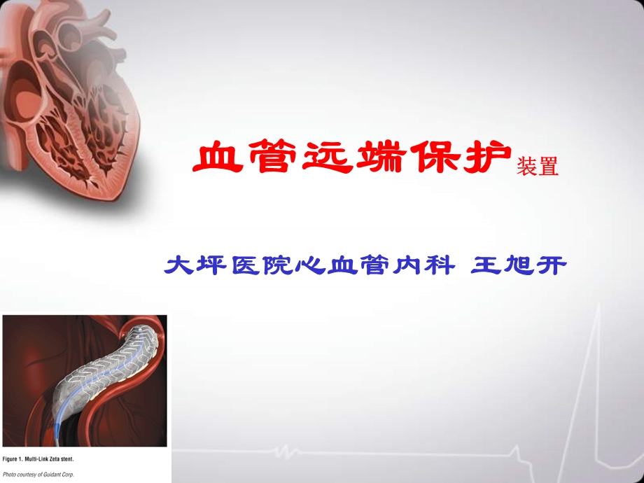 血管远端保护装置大坪医院心血管内科王旭开.ppt_第1页