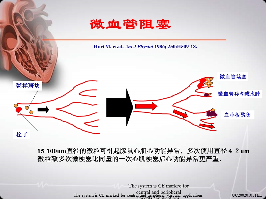 血管远端保护装置大坪医院心血管内科王旭开.ppt_第3页