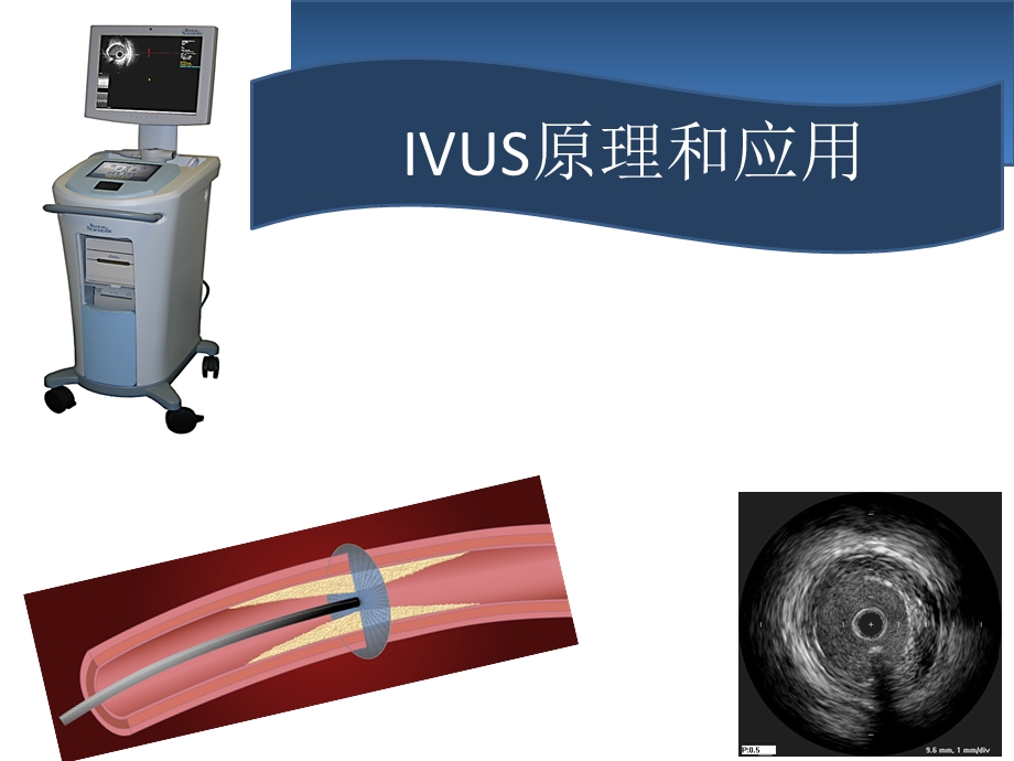 血管内超声IVUS原理和应用.ppt_第1页