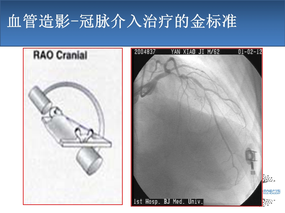 血管内超声IVUS原理和应用.ppt_第2页