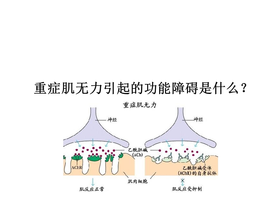 重症肌无力肌松药.ppt_第3页