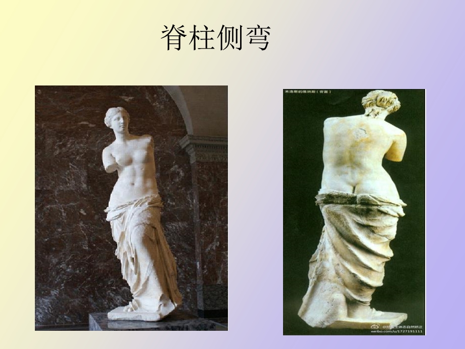 运动学脊柱侧弯.ppt_第1页