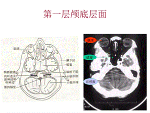 颅脑基本病变的CT诊断.ppt