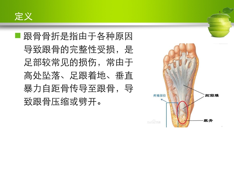 跟骨骨折护理查房.ppt_第2页