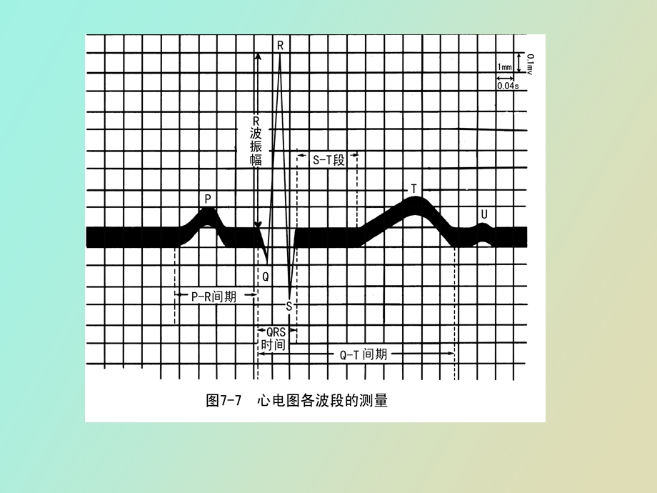 诊断学之常见异常心电.ppt_第3页