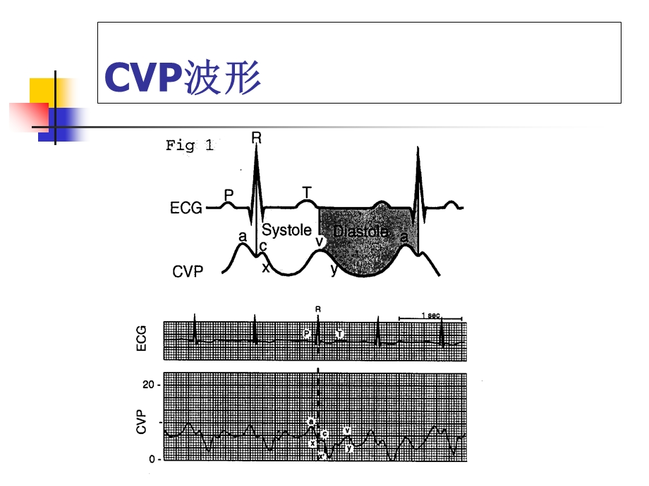 中心静脉压波形监测的意义.ppt_第2页