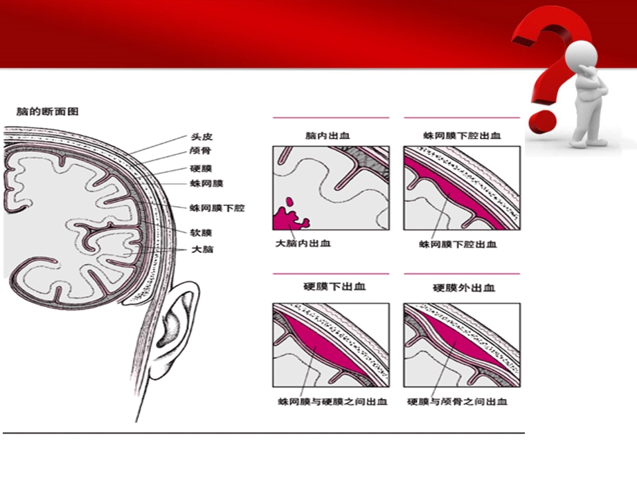 蛛网膜下腔出血的护理措施.ppt_第2页