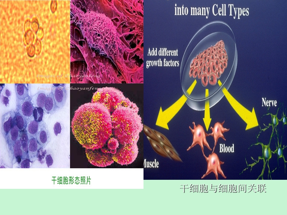 造血干细胞的恶性克隆性疾病.ppt_第3页