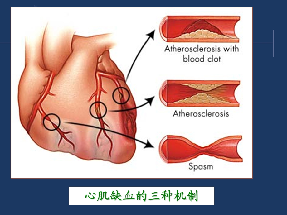 西药综合-第十章-冠状动脉粥样硬化性心脏病.ppt_第3页