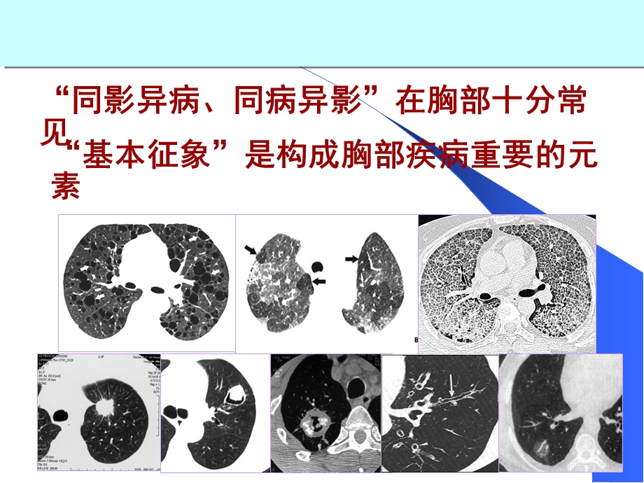 医学ppt肺部ct征象.ppt_第2页