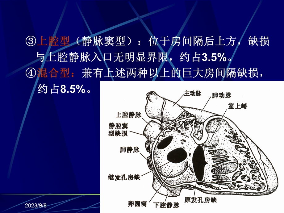 先天性心脏病ppt课件.ppt_第3页