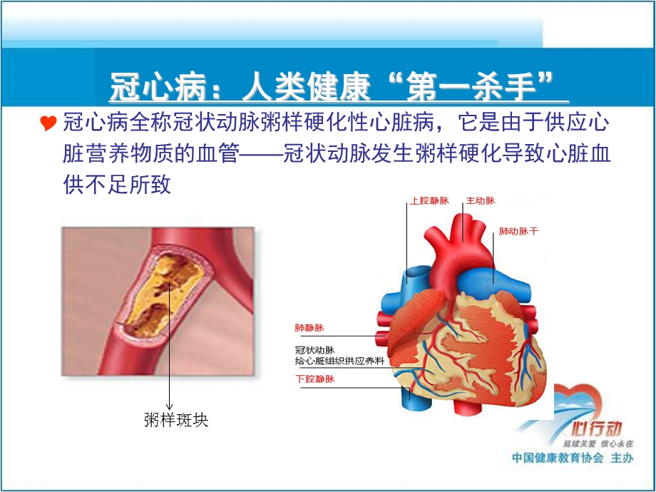 冠心病患者PCI术后健康教育-新(一).ppt_第3页