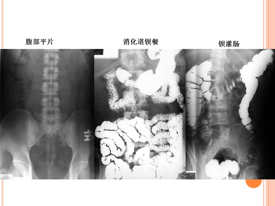 医学影像学-五年制见习课课件：见习腹部一.ppt_第3页