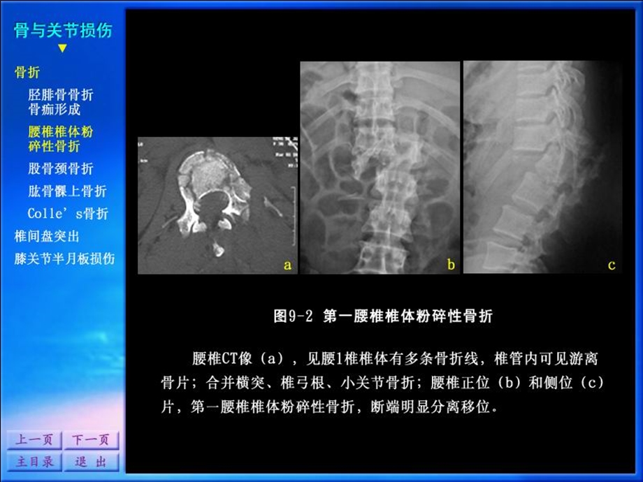 影像诊断学系列图谱骨骼系统.ppt_第3页