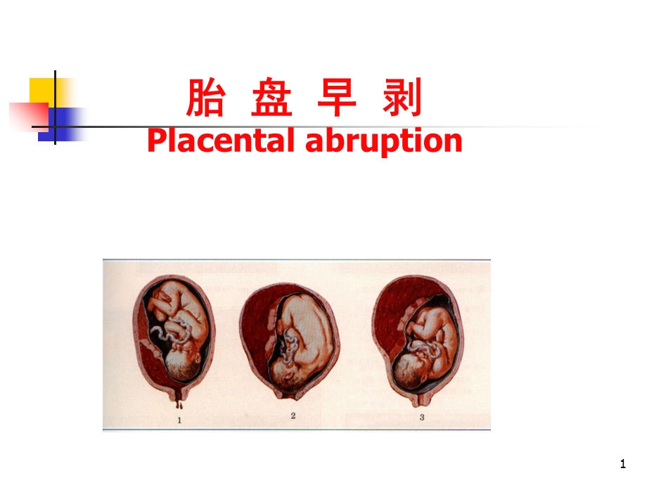 妊娠病-8、早剥胎盘.ppt_第1页