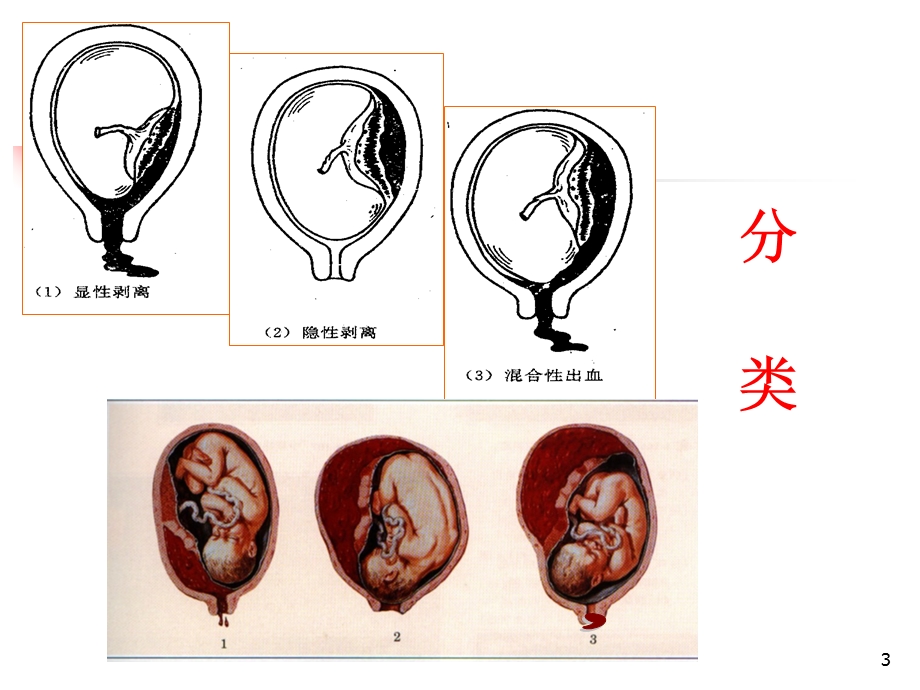 妊娠病-8、早剥胎盘.ppt_第3页