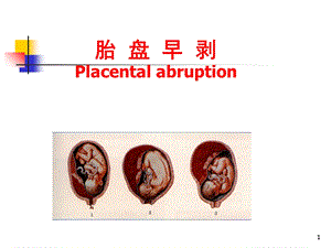 妊娠病-8、早剥胎盘.ppt