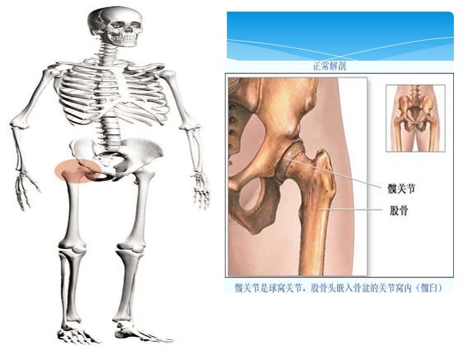 人工髋关节置换术护理.ppt_第3页