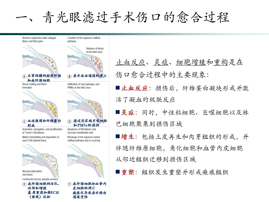 功能性滤过泡的维护.ppt_第3页