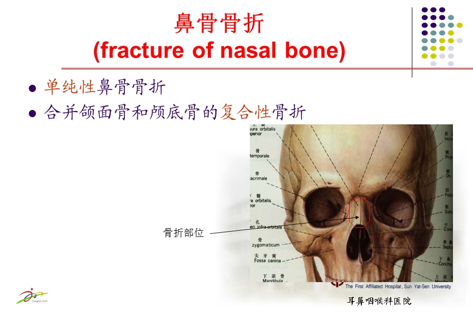 鼻外伤 中山大学附属第一医院.ppt_第3页