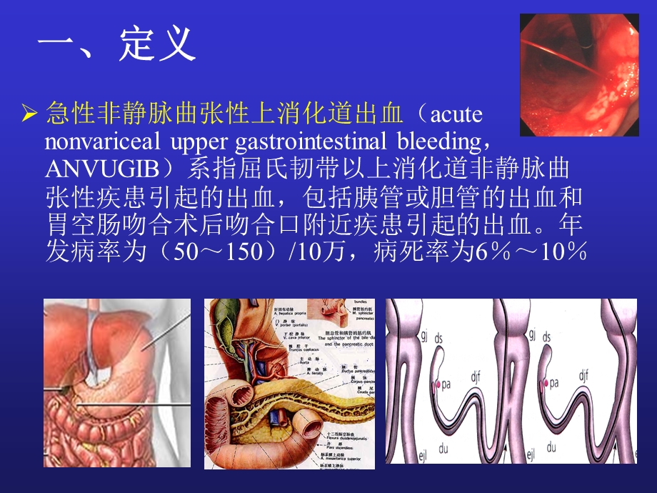 急性非静脉曲张性上消化道出血指南.ppt_第2页