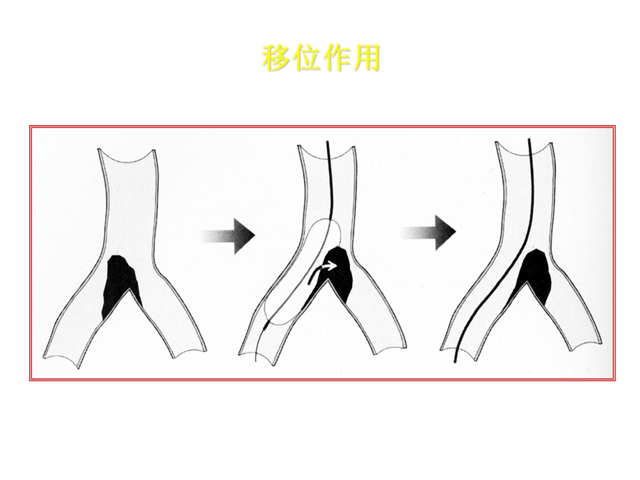 冠脉介入诊疗分叉病变.ppt_第2页