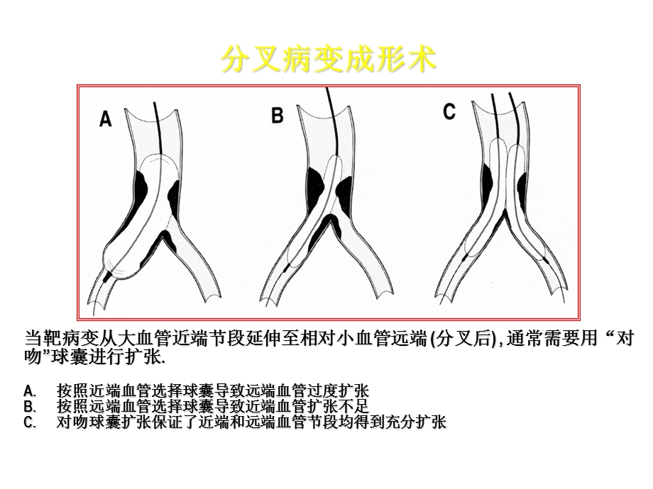 冠脉介入诊疗分叉病变.ppt_第3页