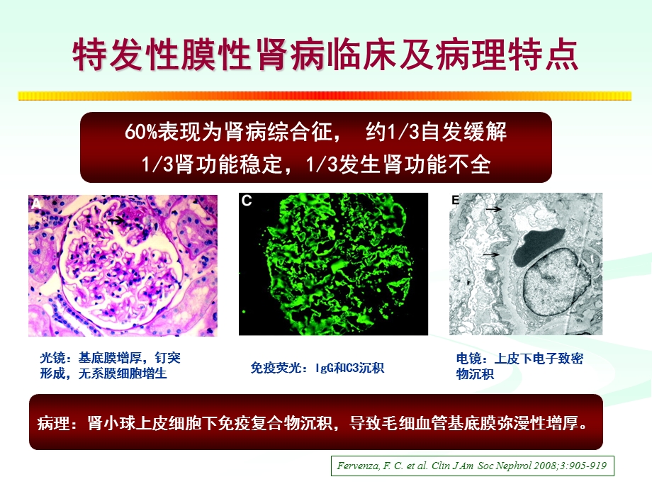 陈江华膜性肾病治疗策略.ppt_第2页