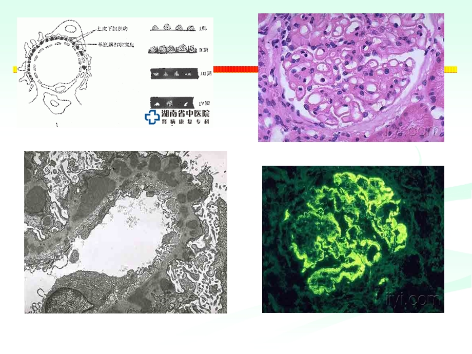 陈江华膜性肾病治疗策略.ppt_第3页