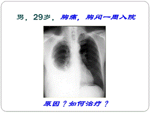 第十一章 胸腔积液 ppt课件.ppt