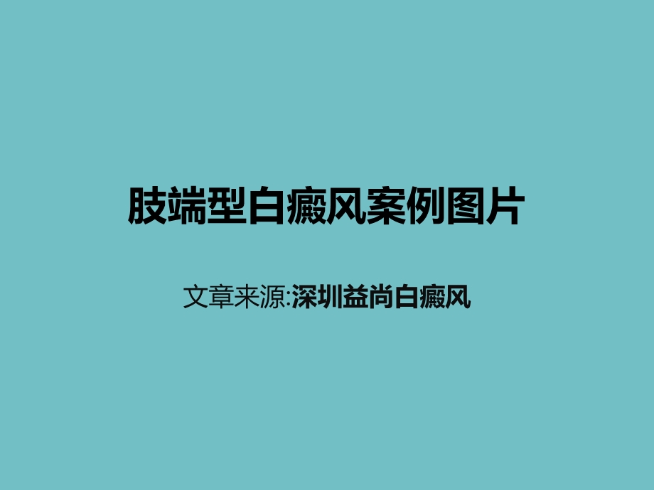 肢端型白癜风常见图片案例.ppt_第1页